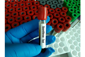 Best TB Test- Quantiferon Gold- An IGRA Test