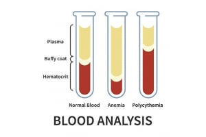 What Does High Hematocrit Mean for Men on TRT ?