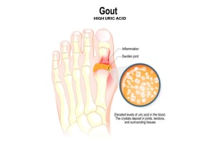 What You Should Know to Prevent Gout - Uric Acid Test