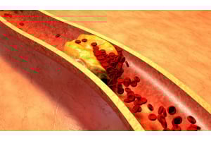 Blood Lipid Levels: Impact on Cardiovascular Disease