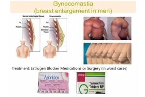 Gynecomastia: Types, Causes, and Treatments