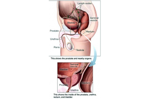 TRT does not increase cancer risk in men treated for prostate cancer