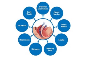 Sleep Apnea: Effect on Testosterone and High Hematocrit