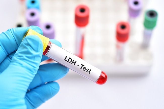 LDH Blood Test at Discounted Labs