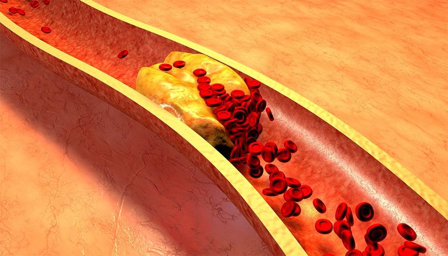 Blood Lipid Levels: Impact on Cardiovascular Disease