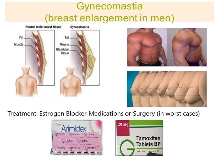 gynecomastia lab tests