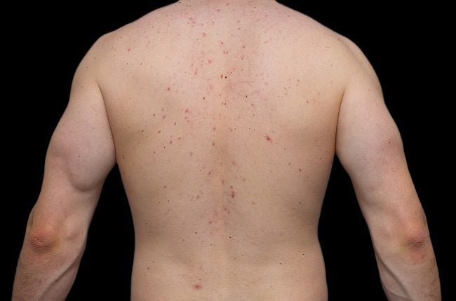 Back Acne From Testosterone Injections
